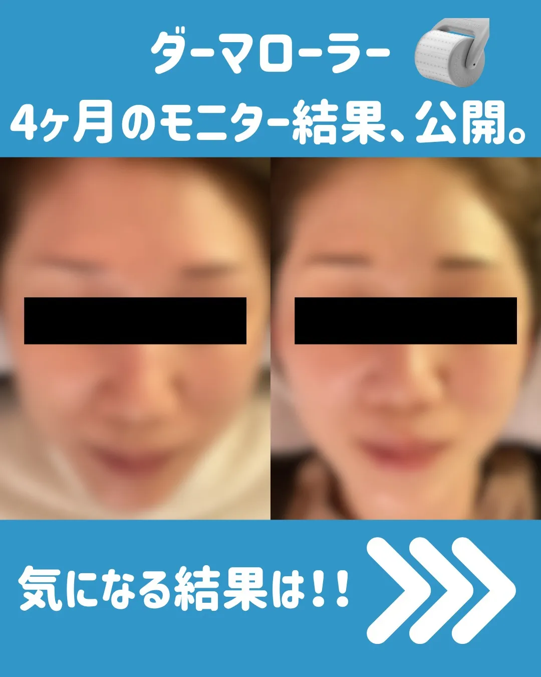 🌟 ダーマローラーと美容鍼の4回コースモニター体験についてシ...