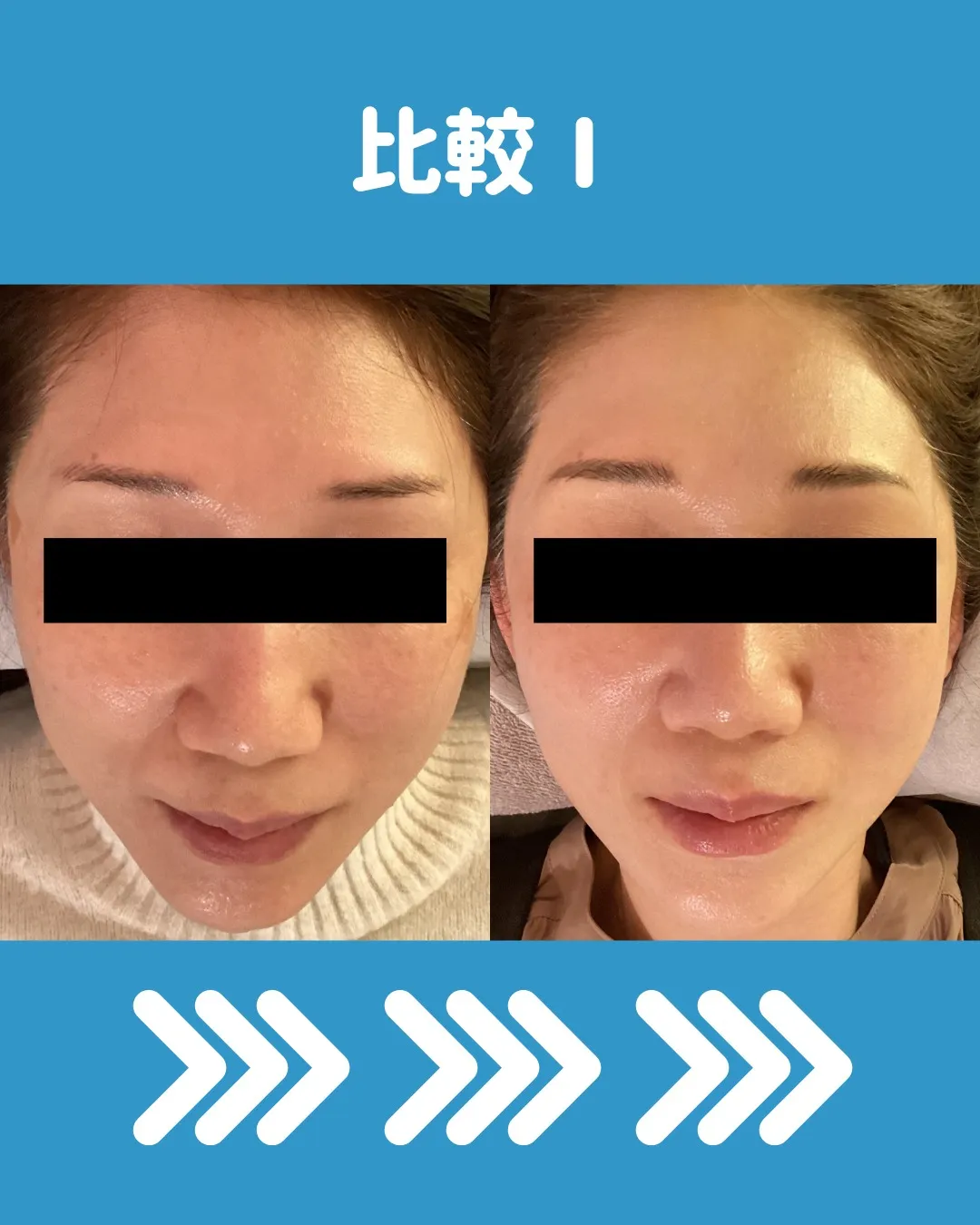 🌟 ダーマローラーと美容鍼の4回コースモニター体験についてシ...