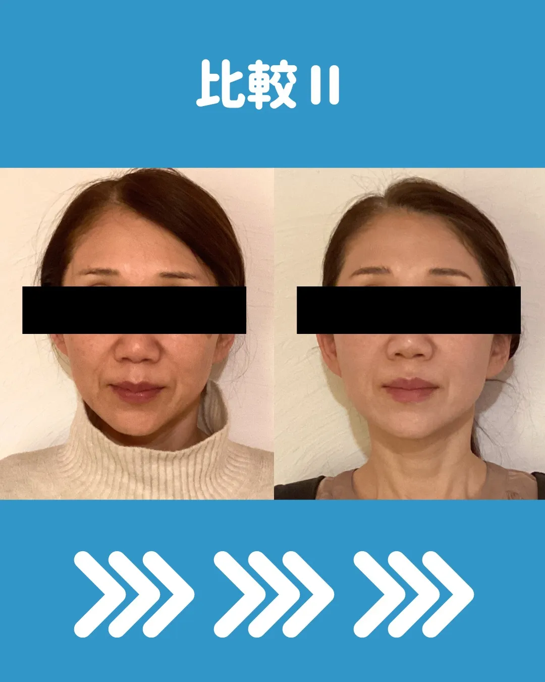 🌟 ダーマローラーと美容鍼の4回コースモニター体験についてシ...