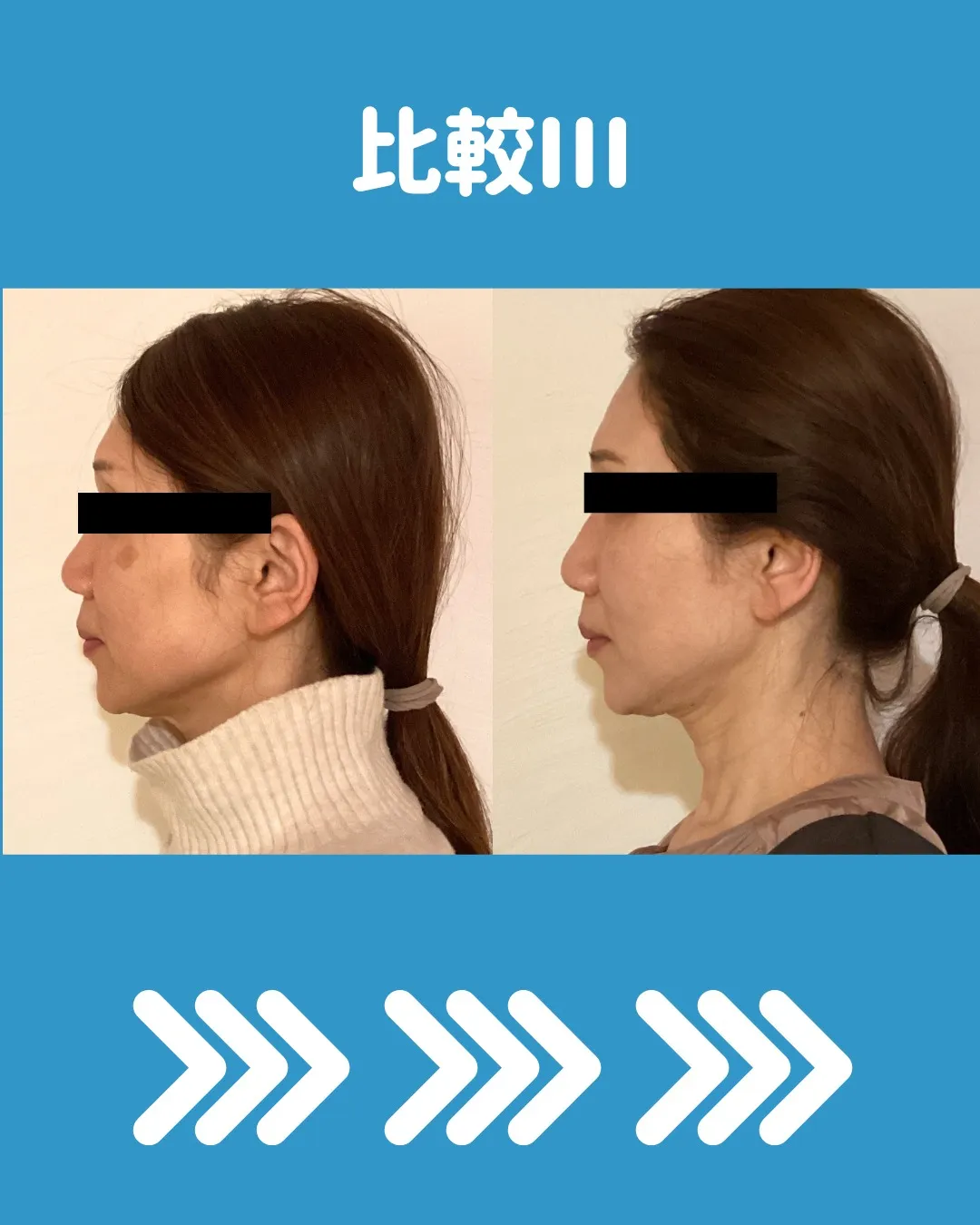 🌟 ダーマローラーと美容鍼の4回コースモニター体験についてシ...