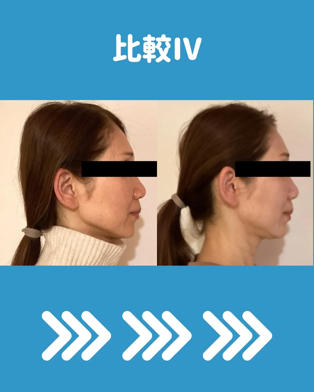 🌟 ダーマローラーと美容鍼の4回コースモニター体験についてシ...